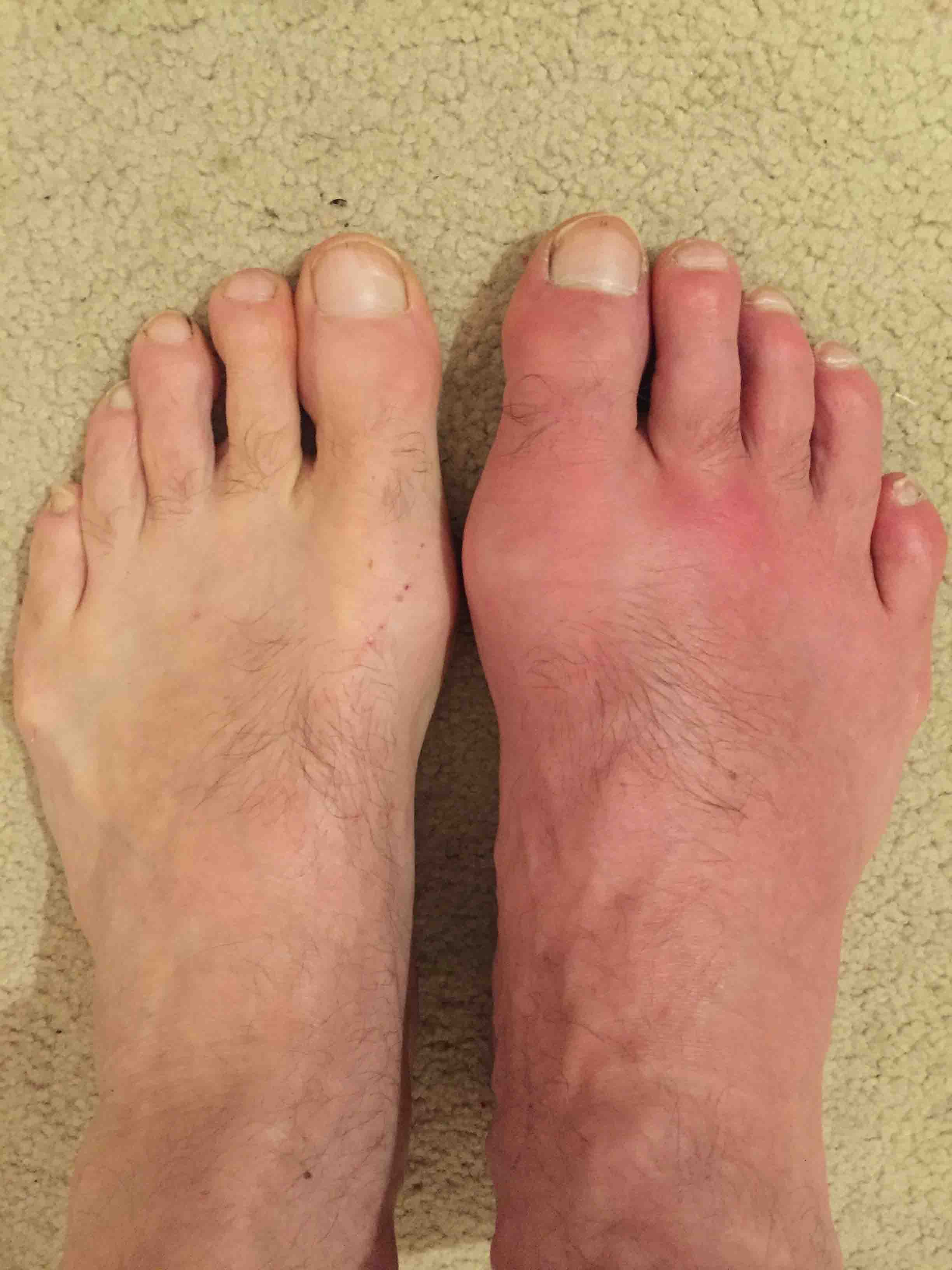 how do you treat gout in feet